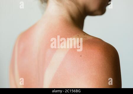 Gros plan d'un coup de soleil sur le dos d'une femme Banque D'Images