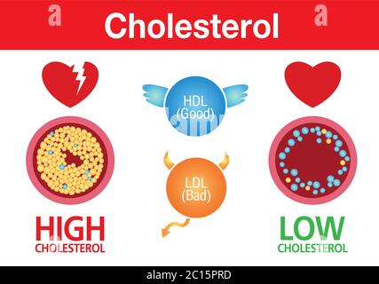 Cholestérol dans l'artère, risque pour la santé, exercice, conception de vecteur Illustration de Vecteur