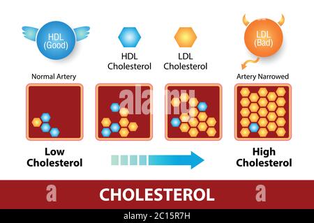 Cholestérol dans l'artère, risque pour la santé, conception de vecteur Illustration de Vecteur