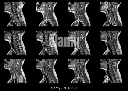 Ensemble d'acquisitions IRM sagittales de la zone du cou du caucase Mâle avec extrusion paramédiale bilatérale du segment C6-C7 avec radiculopathie Banque D'Images