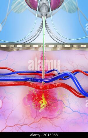 Un moustique infecté par le paludisme transmet les pathogènes du paludisme au sang humain pendant les piqûres de moustiques - illustration 3D Banque D'Images