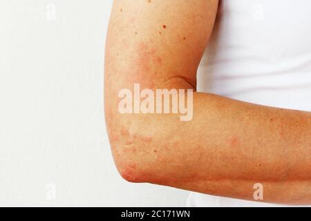 Pustules rouges et vésicules sur la peau de la main comme symptômes de la photodermatite. Réaction allergique à la lumière du soleil. Allergie Banque D'Images