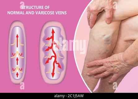 Varices sur les jambes de la femme. La structure des varices et normales. Concept de peau sèche, personnes âgées, varices et thrombose veineuse profonde ou TVP Banque D'Images