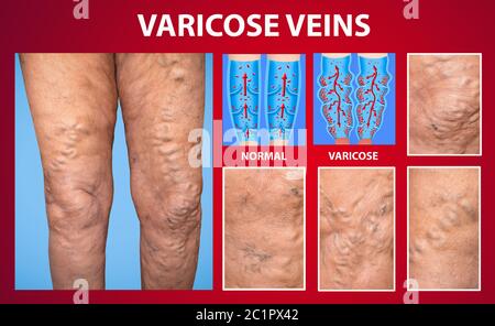 L'ancien âge et malade d'une femme. Varices sur les jambes d'une femme. Le varicosity, varicosités, œdèmes, concept de maladie. Banque D'Images