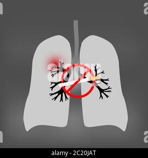 Monde pas de tabac jour. Fumer causant le cancer du poumon. Illustration du poumon humain et du panneau stop-tabac. Fumer peut causer le cancer du poumon. Illustration de Vecteur