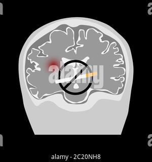 Monde pas de tabac jour. Fumer provoquant un AVC. Illustration du signe d'interdiction de fumer, de l'image coronale du cerveau et de l'accident ischémique cérébral. Illustration de Vecteur