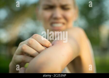 gros plan d'une piqûre de moustique rouge sur le bras d'une personne, la frottant et la grattant à l'extérieur dans le parc. Banque D'Images