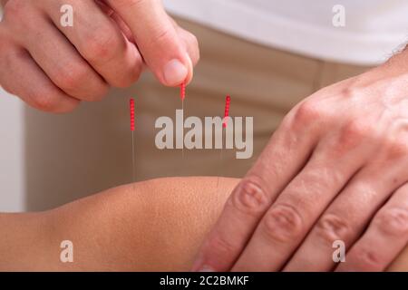 Close-up de la main d'acupuncteur, piquer les aiguilles d'Acupuncture sur le genou en clinique Banque D'Images