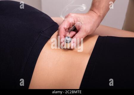 Une vue de dessus d'un médecin d'effectuer une thérapie Moxibustion SUR UNE PATIENTE Retour Banque D'Images