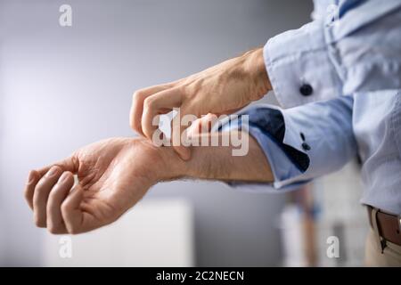 Gros plan d'un homme se gratte la main Banque D'Images