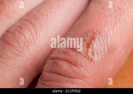Détail de la brûlure infectée sur le doigt d'une femme Banque D'Images