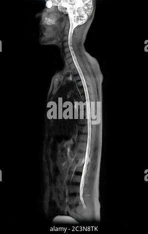 IRM du rachis complet utiliser la technique du myélogramme sur le plan sagittal pour le diagnostic de la compression de la moelle épinière. Banque D'Images