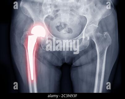 Vue ap des deux hanches avec radiographie montrant un remplacement de la hanche droite ou une prothèse de hanche en titane. Banque D'Images