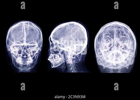 Collection d'images radiologiques du crâne humain AP , vue latérale et vue de l'eau avec image MRV du cerveau montrant les sinus veineux du cerveau dans le crâne. Banque D'Images
