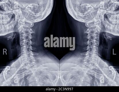 Collection d'images radiographiques du rachis cervical ou d'images radiographiques de la vue oblique du rachis cervical des deux côtés pour l'hernie discale intervertébrale diagnostique. Banque D'Images