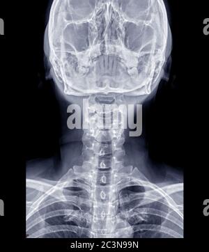 Image radiographique du rachis cervical ou image radiographique du rachis cervical vue AP pour l'hernie discale intervertébrale diagnostique. Banque D'Images