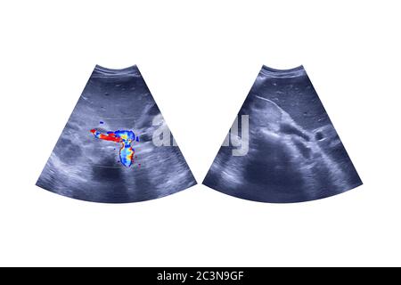 Échographie du haut de l'abdomen montrant et le foie et la vésicule biliaire pour le criblage des cellules hépatiques carcinome du chc isolé sur fond blanc. Clipping Path. Banque D'Images