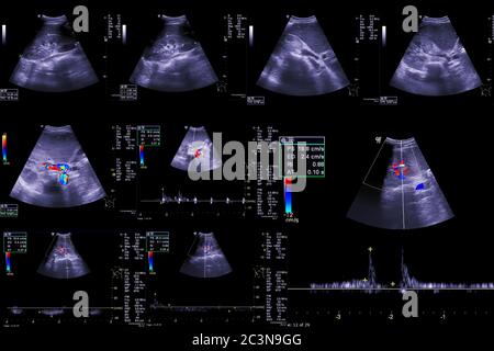 Recueil de l'échographie du haut de l'abdomen montrant anatomique du système hépatobiliaire et du foie et de la vésicule biliaire pour le criblage du carcinome de cellules hépatiques de Banque D'Images