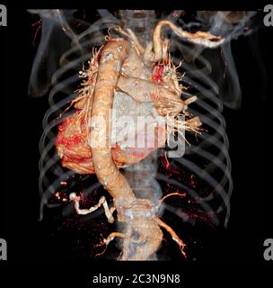 Vue postérieure ou arrière de l'aorte thoracique 3D CTA pour anévrisme aortique ou AAA et dissection aortique diagnotique Banque D'Images