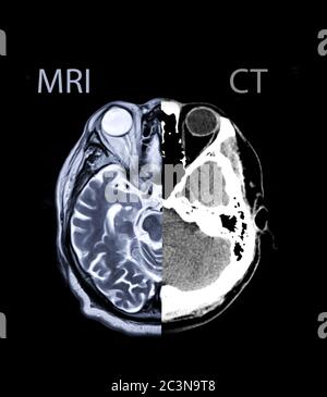 Comparer et mélanger l'image axiale du cerveau TDM et l'image axiale du cerveau IRM. Concept d'arrière-plan. Banque D'Images