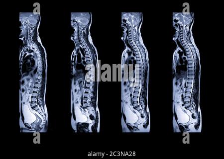 Collection d'IRM du plan sagittal T2W de la colonne vertébrale entière pour la compression diagnostique de la moelle épinière. Banque D'Images