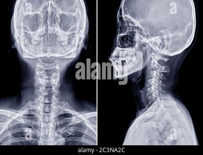 Radiographie du rachis cervical ou radiographie du rachis cervical vue AP et latérale pour une hernie discale intervertébrale diagnostique. Banque D'Images