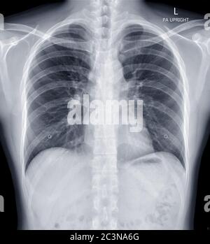 Radiographie thoracique ou radiographie image du thorax humain pour le diagnostic de tuberculose . vérifier concept. Banque D'Images