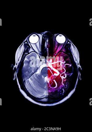 IRM et MRA Brain se comparent en vue axiale. Banque D'Images