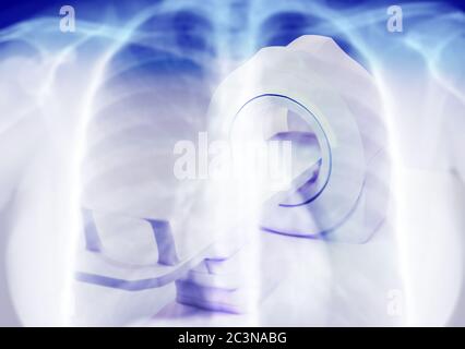 Image de fusion du scanner CT multidétecteur ( tomodensitométrie ) sur fond de radiographie thoracique pour le diagnostic covid - 19. Banque D'Images