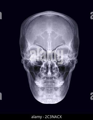 Image radiographique du crâne du crâne humain vue AP ou vue de face isolée sur fond noir. Masque. Banque D'Images