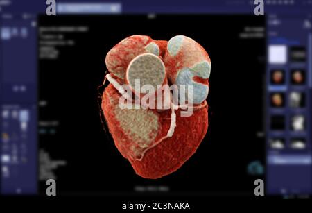Image de rendu 3D de l'artère coronaire CTA pour détecter une maladie coronarienne sur un arrière-plan d'écran flou. Banque D'Images