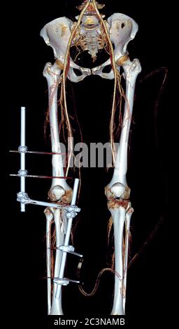 L'artère fémorale CTA est une image de rendu 3D de l'artère fémorale destinée à détecter les lésions vasoculaires chez un patient traumatique. Banque D'Images