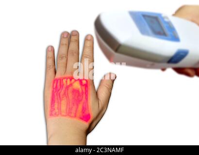 Viseur de veine infrarouge portable de la main gauche montrant la veine céphalique et la veine basilique pour le test d'échantillon sanguin Banque D'Images