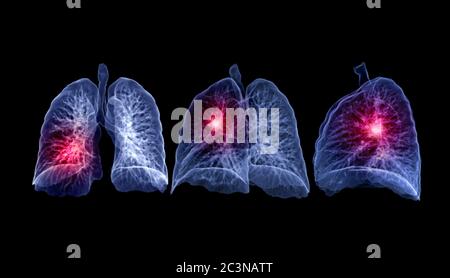 Collection d'images de rendu CT thorax ou poumon 3D montrant la lésion pour le diagnostic TB, tuberculose et Covid-19 . Banque D'Images