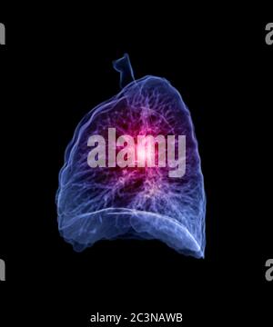 Foyer sélectif de l'image de rendu CT thorax ou poumon 3D vue latérale gauche montrant la lésion pour le diagnostic TB, tuberculose et Covid-19 . Banque D'Images