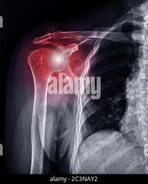 Articulation de l'épaule à rayons X pour le diagnostic de la luxation de l'articulation de l'épaule. Banque D'Images