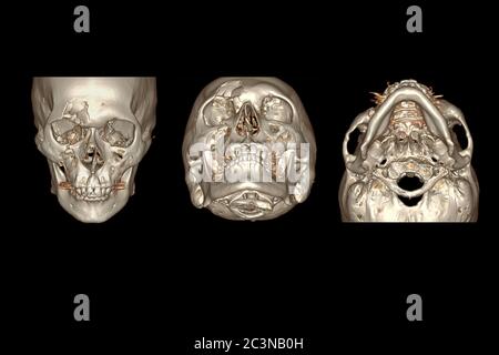 Image de rendu 3D de l'os facial CT isolée sur fond noir montrant une fracture de l'os frontal . Banque D'Images