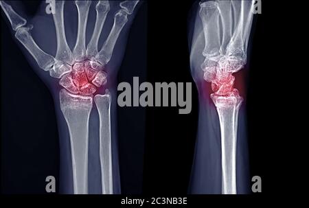 Image radiographique de l'articulation du poignet droit AP et vue latérale pour le diagnostic de la polyarthrite rhumatoïde . Banque D'Images