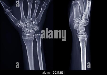 Image radiographique de l'articulation du poignet droit AP et vue latérale pour le diagnostic de la polyarthrite rhumatoïde . Banque D'Images