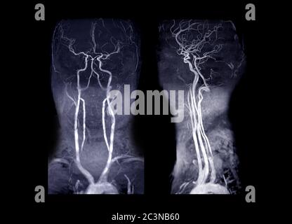 ARM angiographie par résonance magnétique ou cérébrale ( ARM ) de l'artère cérébrale et de l'artère carotide commune AP et vue latérale pour les évaluer ste Banque D'Images