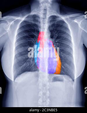 Image de fusion de l'image radiographique thoracique et de l'image d'artère coronaire 3D CTA montrant le cœur à l'intérieur de la poitrine pour le concept de vérification. Banque D'Images