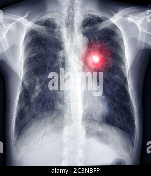 Image de fusion de rayons X thoracique avec CT image de rendu 3D thoracique ou pulmonaire pour le diagnostic TB, tuberculose et Covid-19 . Banque D'Images