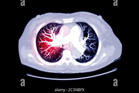 Foyer sélectif de la vue MIP AXIALE CT du thorax pour l'embolie pulmonaire (PE) diagnostique, le cancer du poumon et le covid-19. . Banque D'Images