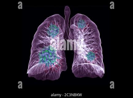 CT image de rendu 3D thorax ou poumon avec rendu 3D virus sur fond noir pour le diagnostic TB, tuberculose et Covid-19 . Banque D'Images