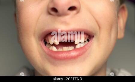 Enfant montrant des dents manquantes, il a perdu deux dents de calfs. Portrait en gros plan d'un garçon blanc blond souriant sans deux dents de devant. Banque D'Images