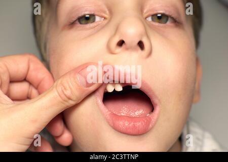 Enfant montrant des dents manquantes, il a perdu deux dents de calfs. Portrait en gros plan d'un garçon blanc blond souriant sans deux dents de devant. Banque D'Images