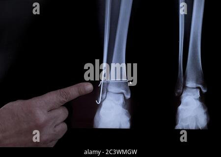 Rayons X de la jambe après l'opération - fils dans la jambe. Le médecin pointe un doigt sur la zone d'opération. Banque D'Images