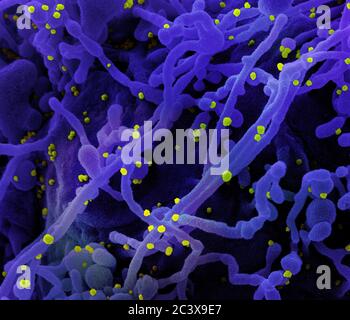 Nouveau coronavirus SRAS-COV-2 Micrographe électronique à balayage colorisé d'une cellule (violette) infectée par des particules du virus SRAS-COV-2 (jaune), isolée d'un échantillon de patient. Image capturée au NIAID Integrated Research Facility (IRF) à fort Detrick, Maryland. Banque D'Images