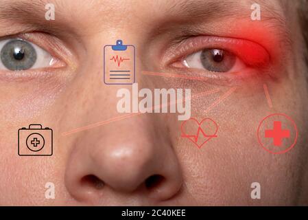 Fermer l'abcès de la paupière supérieure gauche. Œil avec orge. Maladies de l'orge, le concept de développement de la maladie. Banque D'Images