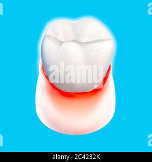 Dent, gomme endolorie, rougeur, dentisterie, nettoyage dentaire, hygiène buccale. Utilisation de dentifrice pour protéger la dent de la formation de plaque, rendu 3d Banque D'Images